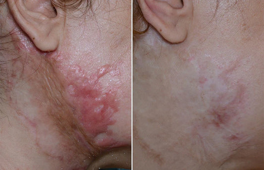 ReGenScar Stem Cell Scar Gel