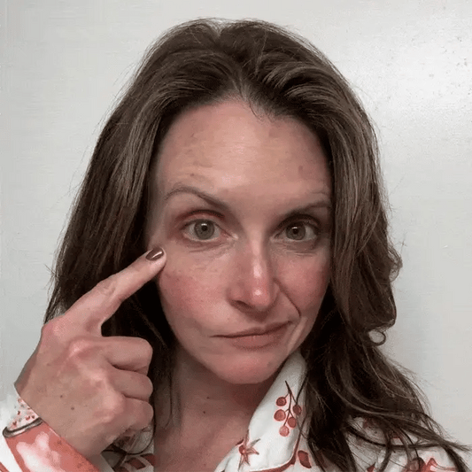 Dissolving Microneedle Eye Patches