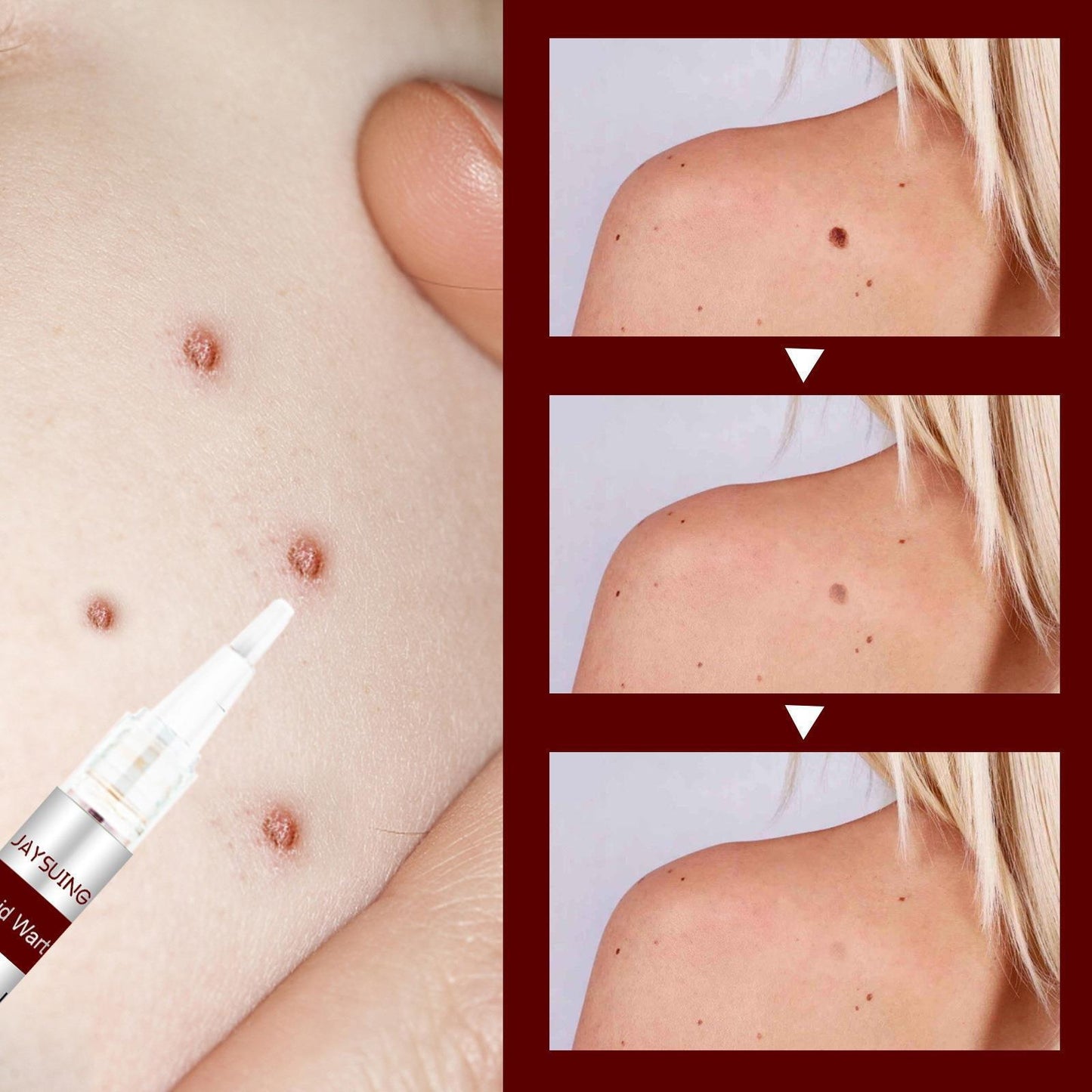 Fivfivgo WipeOff Tags & Mole Remover