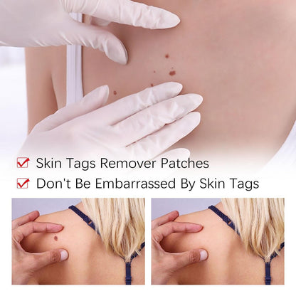 Fivfivgo WipeOff Tags & Mole Remover