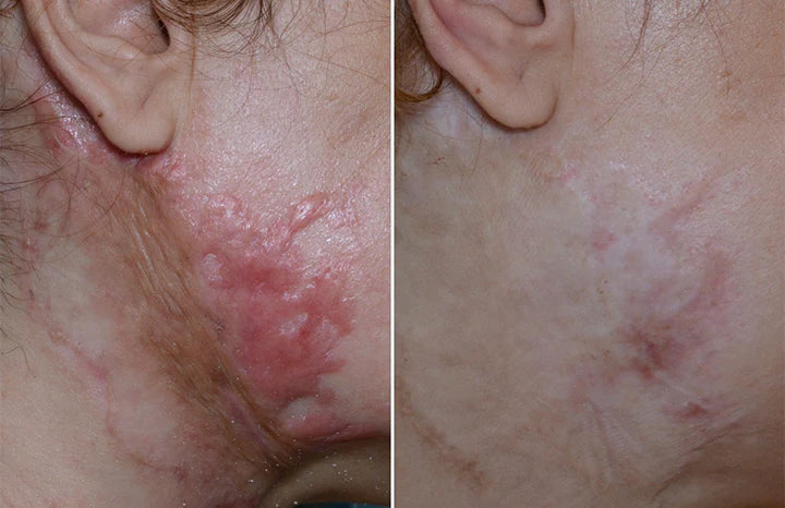 ReGenScar Stem Cell Scar Gel