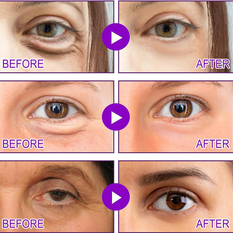 Dissolving Microneedle Eye Patches