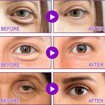 Dissolving Microneedle Eye Patches